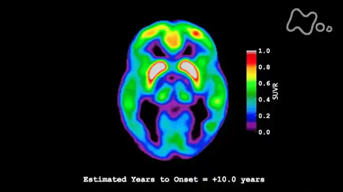 NHKスペシャル アルツハイマー病をくい止めろ!